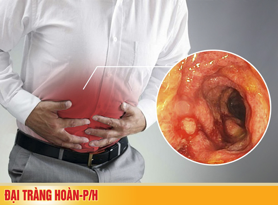 Viêm đại tràng cấp tính: triệu chứng, nguyên nhân và điều trị và phòng bệnh